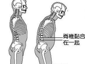 强直性脊柱炎发病症状
