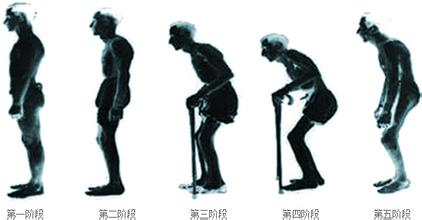 强直性脊柱炎危害