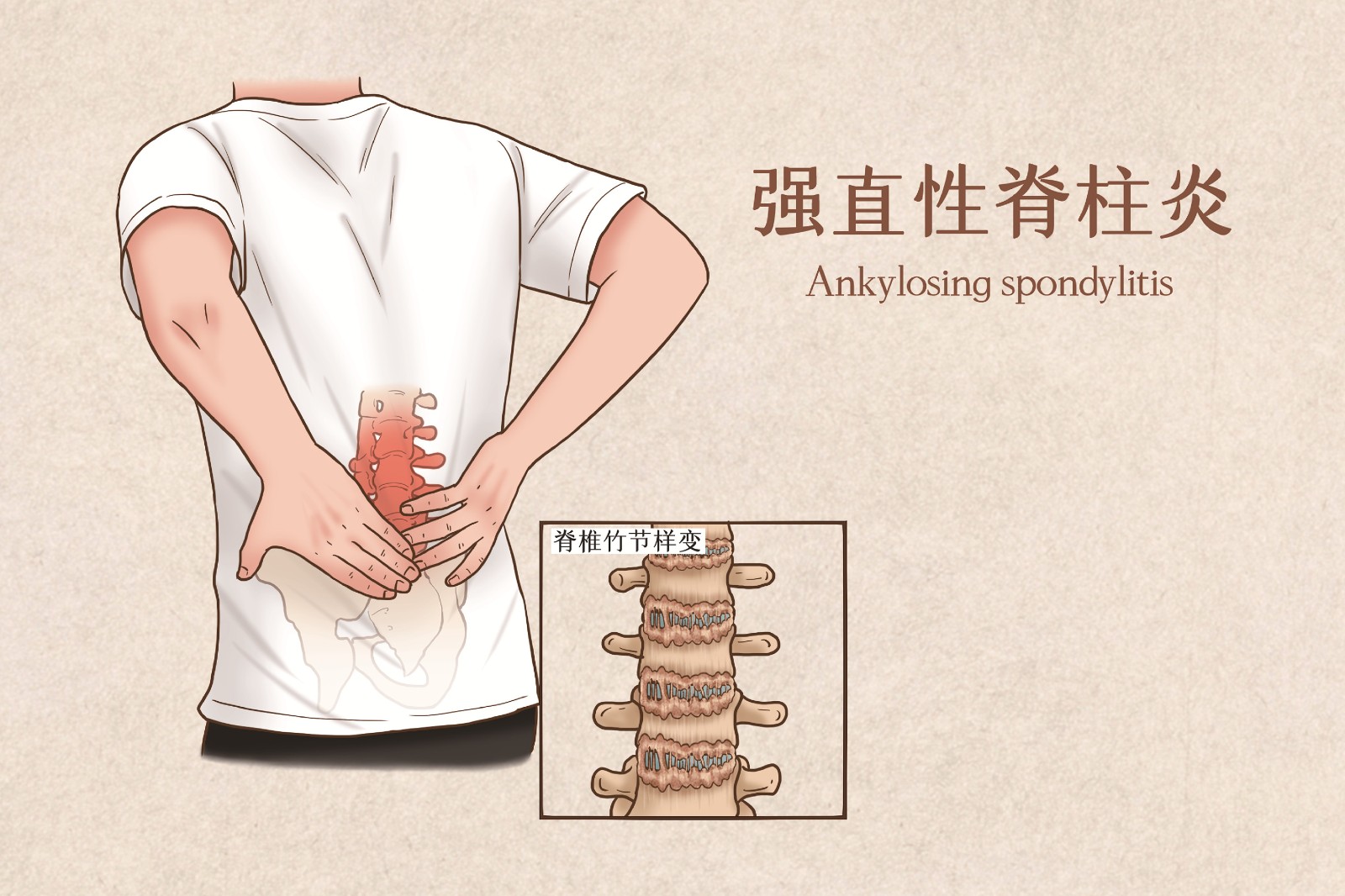 脊柱炎.jpg